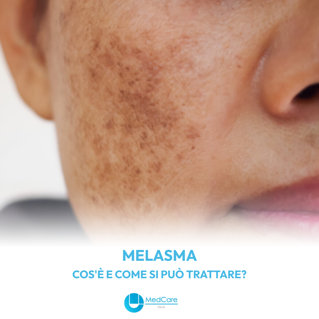 Melasma: cos’è e come si può trattare?